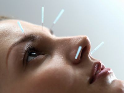 Ce este acupunctura faciala ?