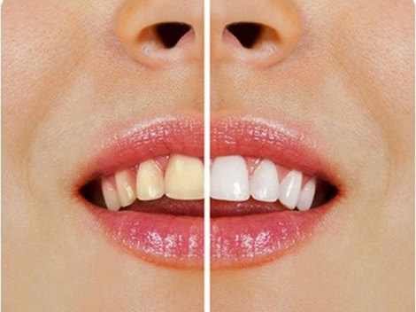 Tipuri de pete ce pot aparea pe dinti si cum sa le indepartati