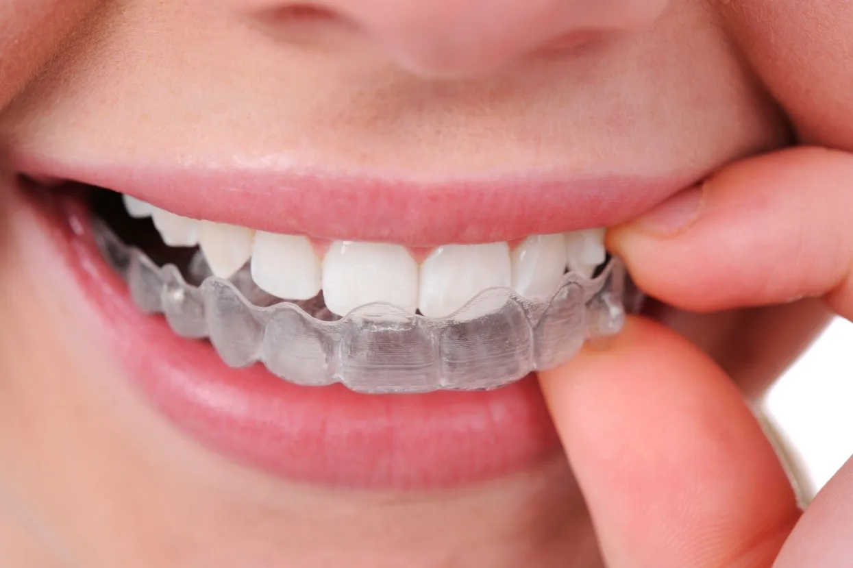 Sfaturi utile pentru cei care poarta aparat dentar