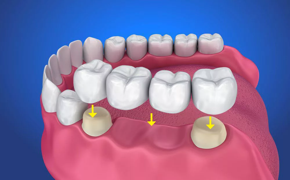 De cate tipuri sunt coroanele dentare?
